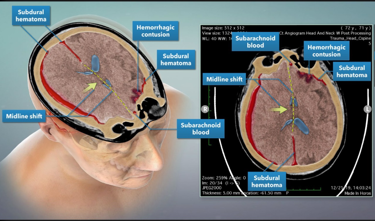 Imaging of Plaintiff's Traumatic Brain Injury