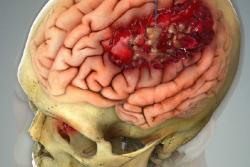 Medical Imaging of Brain Injury